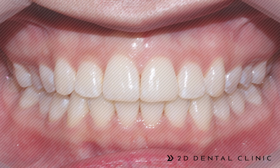 앞니 덧니 부분교정 케이스 전후비교, 교정전문 2D치과 관련 이미지 9