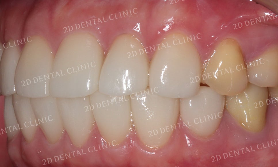 누렇고 손상된 치아를 밝고 가지런하게! by. 투디치과(2D치과)_블링스 시술후기 관련 이미지 10