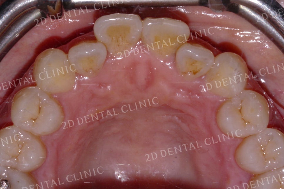 반대교합으로 물리는 치아를 바른 교합으로 교정하기! by.투디치과(2D치과) 관련 이미지 14