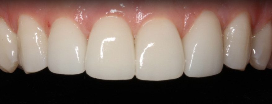 치아변색 개선은 무삭제라미네이트 블랙필름 관련 이미지 7