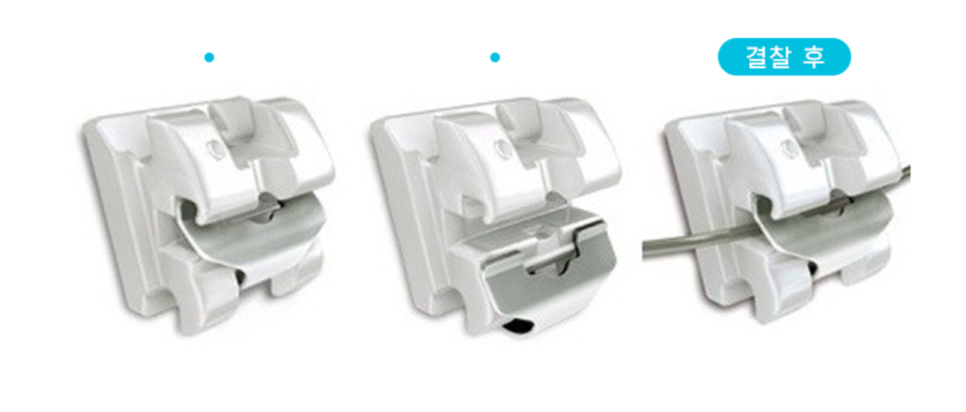 [투디(2D)치과] 클리피씨 교정에 대해 알아보자! 관련 이미지 4