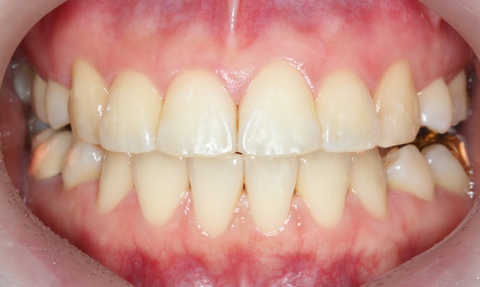 대치동치과 입툭튀 집어넣는 교정 관련 이미지 8