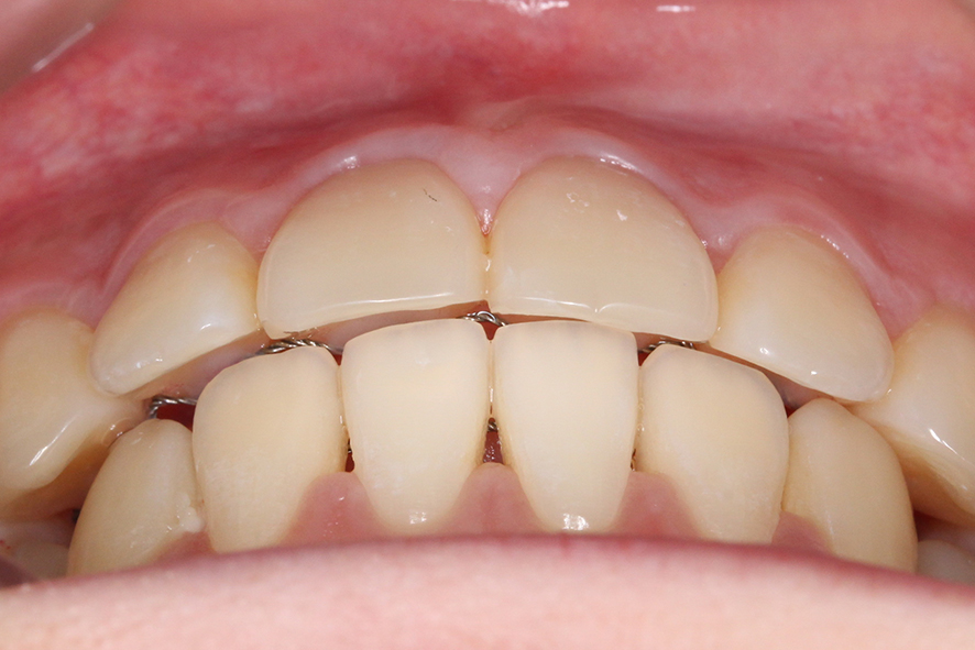 입돌출 데이몬교정 Case1 관련 이미지 10