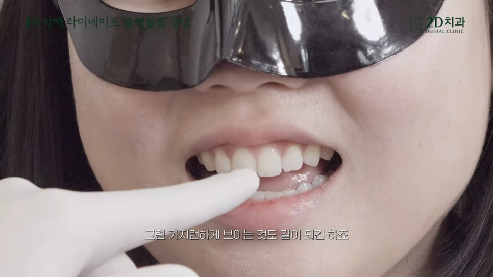 [블랙필름 상담받고 왔어요] #3 앞니가 깨졌어요 관련 이미지 29
