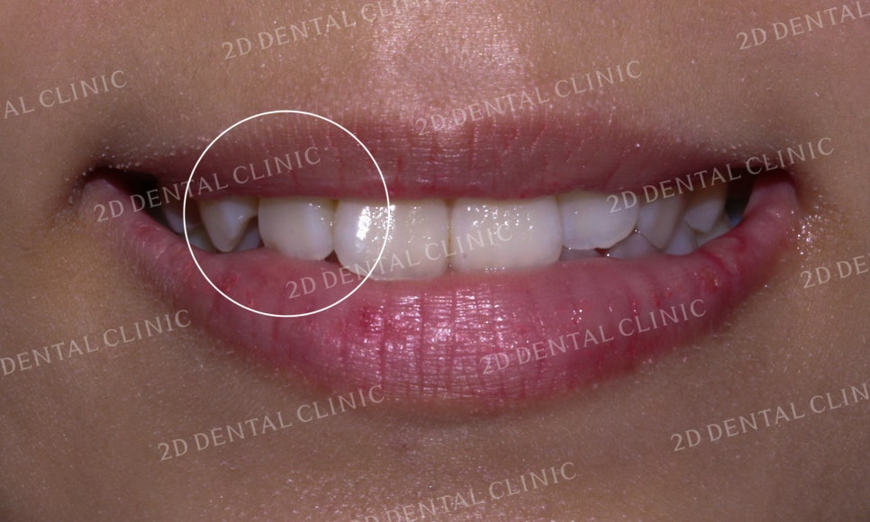 토끼앞니, 튀어나온 앞니 부분교정 후기! by.투디치과(2D치과) 관련 이미지 3