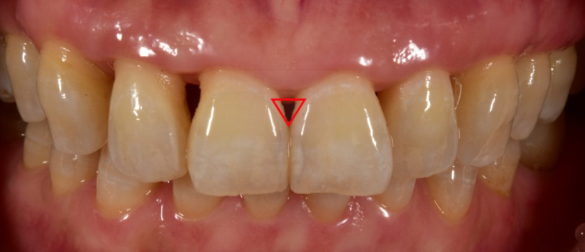 치아변색 개선은 무삭제라미네이트 블랙필름 관련 이미지 4