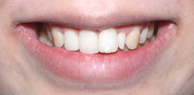 라미네이트에서 중요한 것은..심미적 요소, 블링스 관련 이미지 2