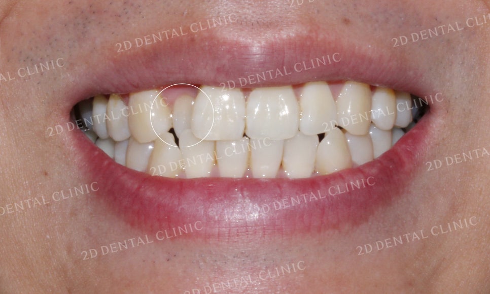 [앞니교정]부정교합교정, 부분교정으로 완성하기! by.투디치과(2D치과) 관련 이미지 9