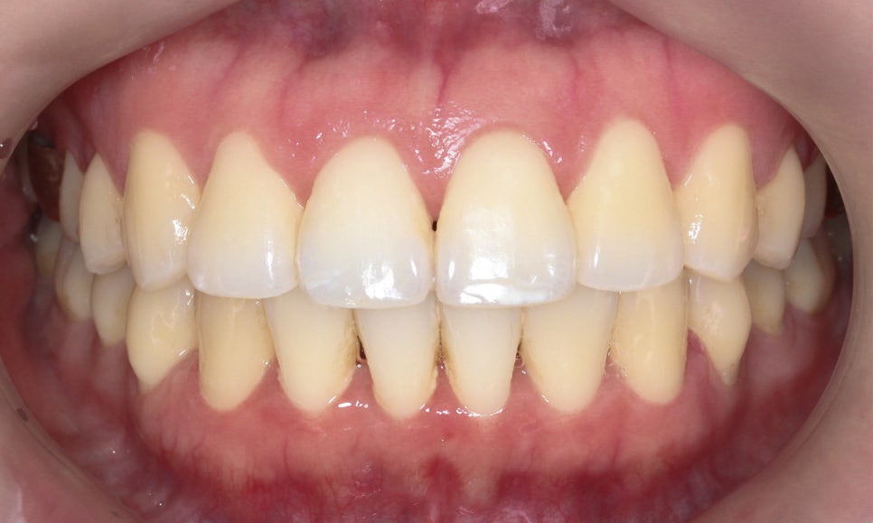 입툭튀 교정 신논현역치과 전체교정으로 관련 이미지 8