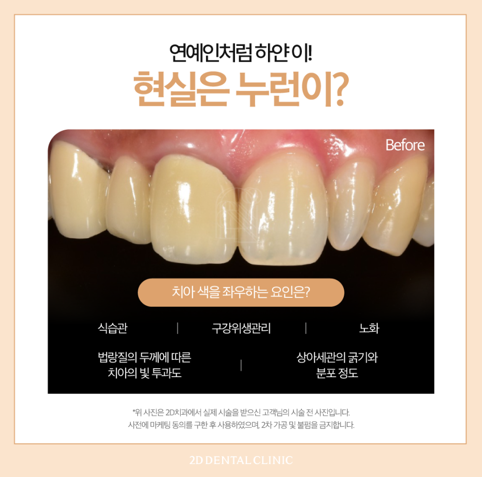 서초치과 치아변색치료 미백도 블랙필름으로 관련 이미지 3