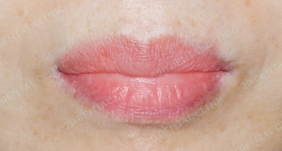 2D치과(투디치과) 교정일기 ㅣ 잇몸질환 예방되는 치아교정(feat.어머님교정) 관련 이미지 9