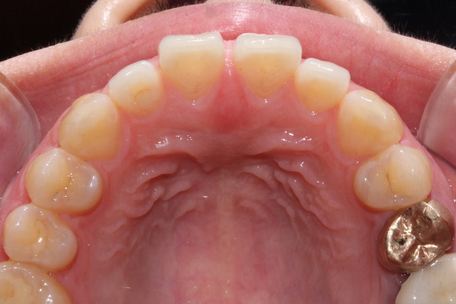 벌어진앞니 치간이개 공간 삭제하기! 관련 이미지 4