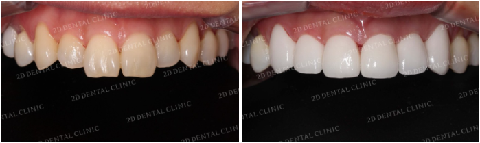앞니라미네이트 잘하는 곳 : 2D치과 관련 이미지 8
