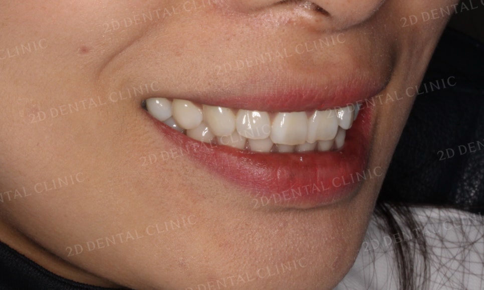 [부분교정] 틀어진 앞니, 부분교정으로 앞니교정하기! by.투디치과(2D치과) 관련 이미지 4