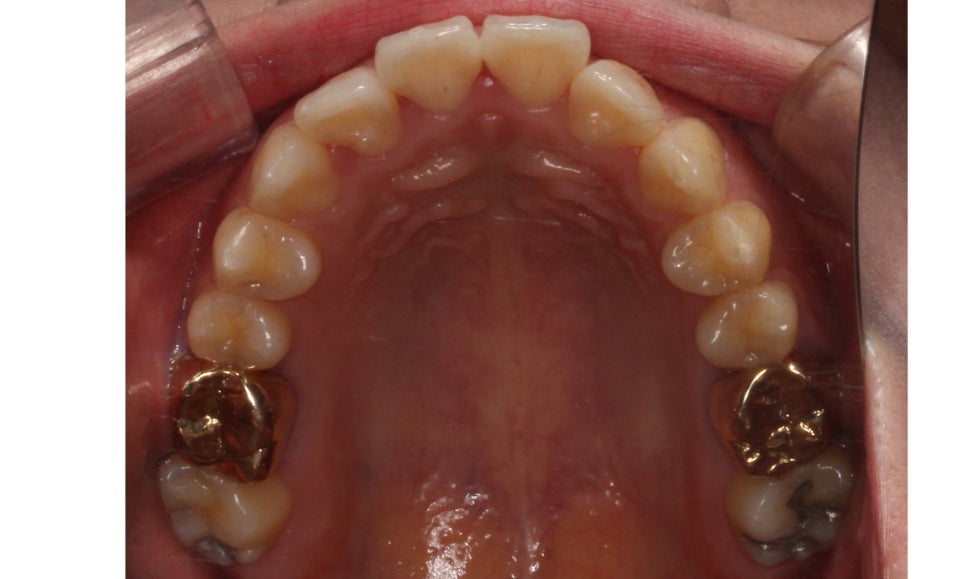 입툭튀 교정 신논현역치과 전체교정으로 관련 이미지 6