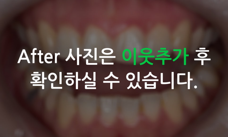 덧니교정 2D교정 (부분교정) 후기 관련 이미지 12
