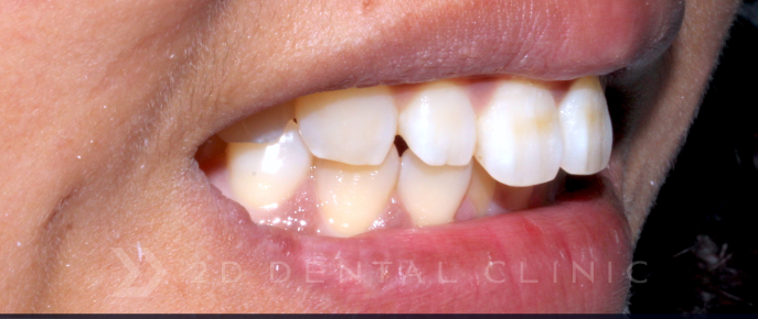 블랙필름 치아 삭제없는 무삭제라미네이트 후기 관련 이미지 8