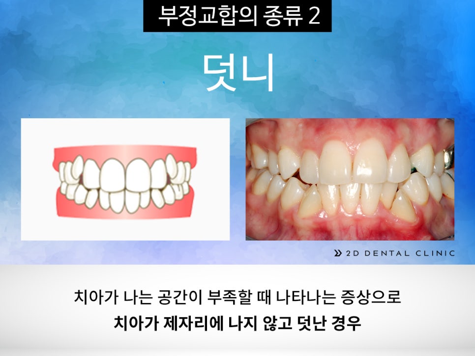 [교정상식] 부정교합 종류! 나는 어떤 케이스에 해당될까? 관련 이미지 5