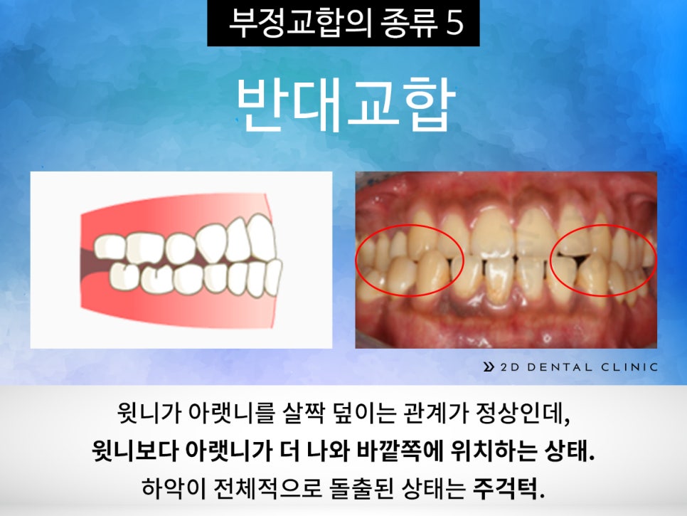 [교정상식] 부정교합 종류! 나는 어떤 케이스에 해당될까? 관련 이미지 8