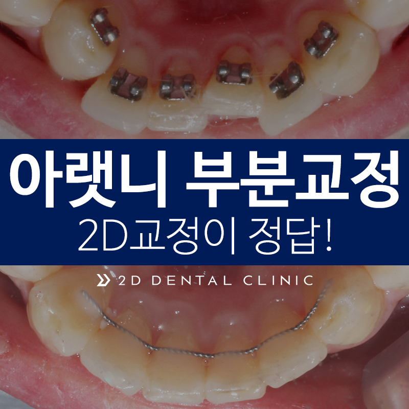 아랫니 부분교정, 2D치과에서 2D교정! 관련 이미지 2