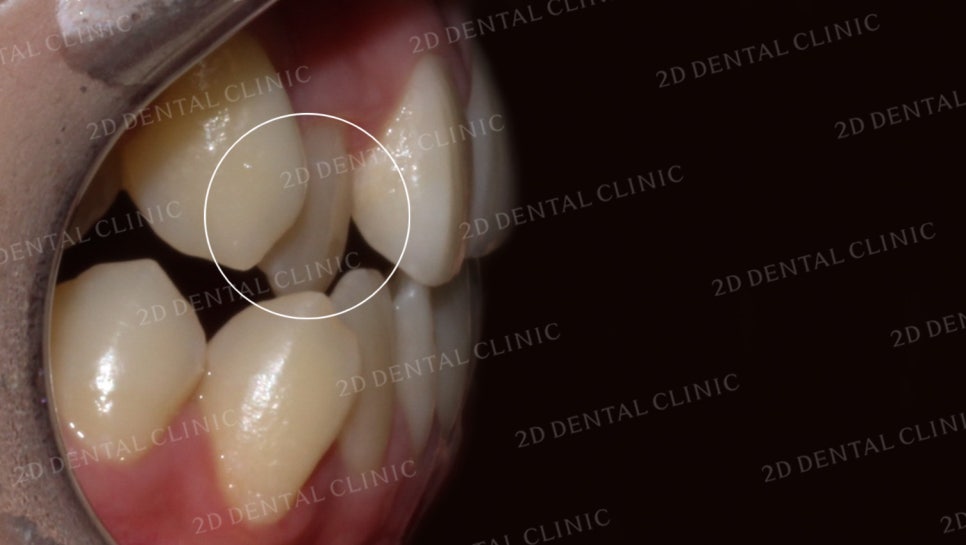 덧니치아교정, 클리피씨 전체교정으로 완벽하게! by.투디치과(2D치과) 관련 이미지 10