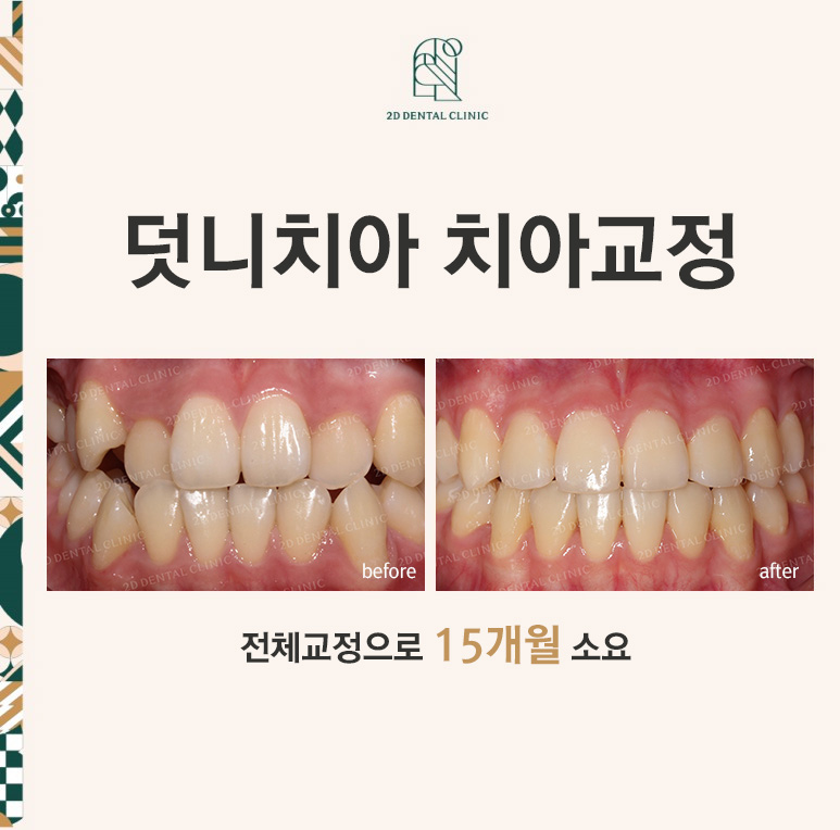 덧니치아교정, 클리피씨 전체교정으로 완벽하게! by.투디치과(2D치과) 관련 이미지 1