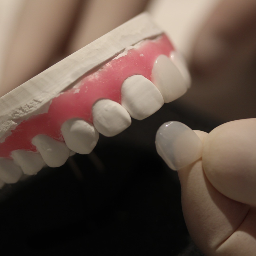 앞니 무삭제 라미네이트 변색치아 블랙필름 시술로 개선완료 관련 이미지 2