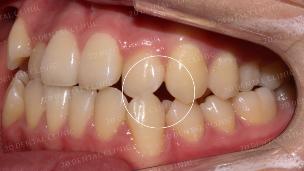 덧니치아교정, 클리피씨 전체교정으로 완벽하게! by.투디치과(2D치과) 관련 이미지 14