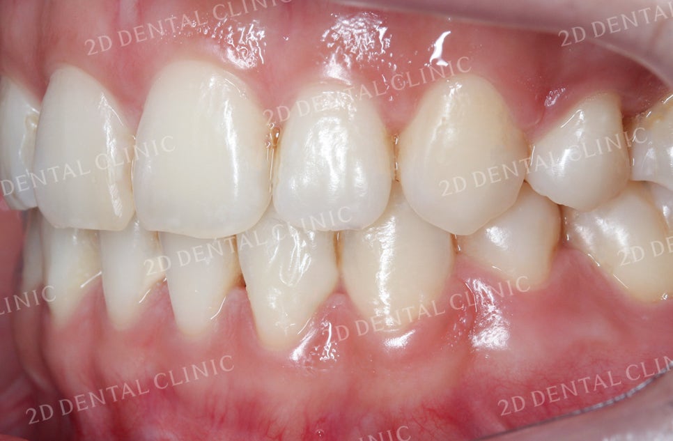 비대칭 앞니, 돌출앞니를 전체 교정으로 교정하고 싶다면!? by.투디치과(2D치과) 관련 이미지 18