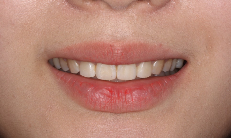 나비치아교정, 부분 치아교정으로 하고 싶다면? by.투디치과(2D치과) 관련 이미지 8