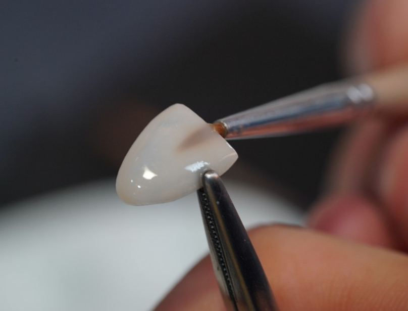 앞니라미네이트 치아삭제없는 무삭제라미네이트 블랙필름 관련 이미지 5