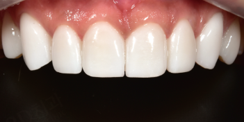 치아변색 고민없는 무삭제라미네이트 블랙필름 관련 이미지 7