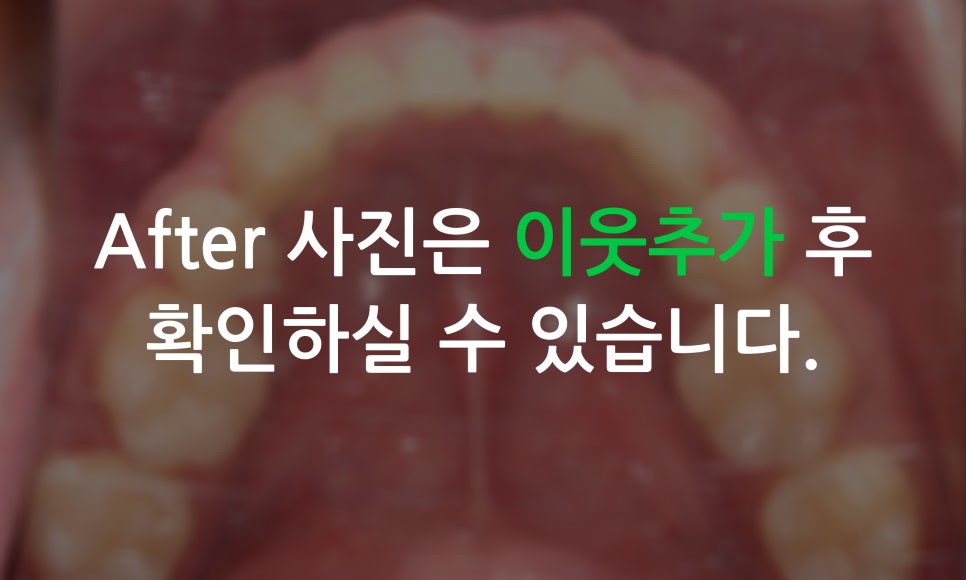 송곳니덧니가 있을 때 교정하는 방법! 관련 이미지 8