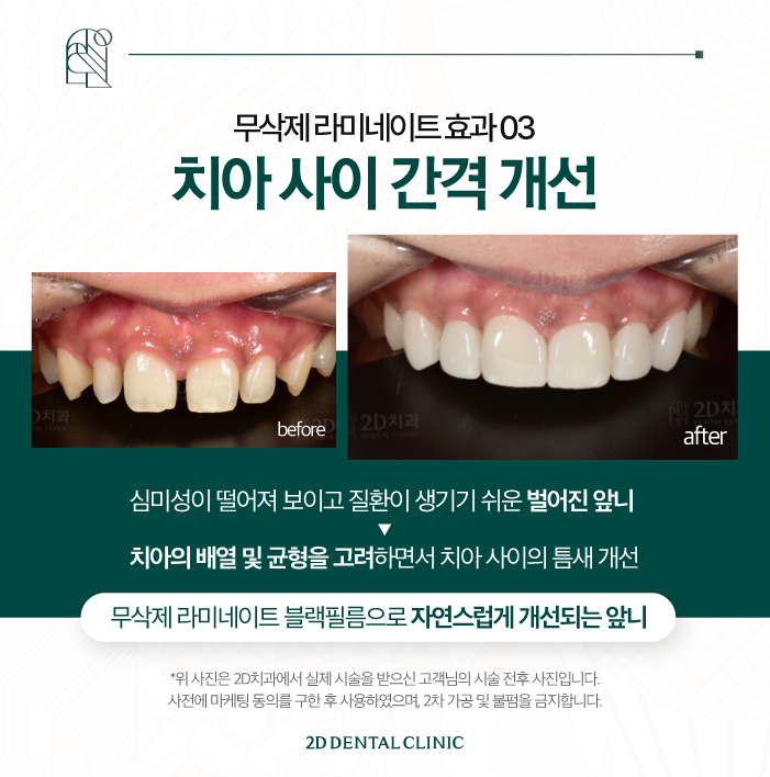 치아 무삭제 라미네이트 블랙필름 효과, 만족도는? 관련 이미지 6
