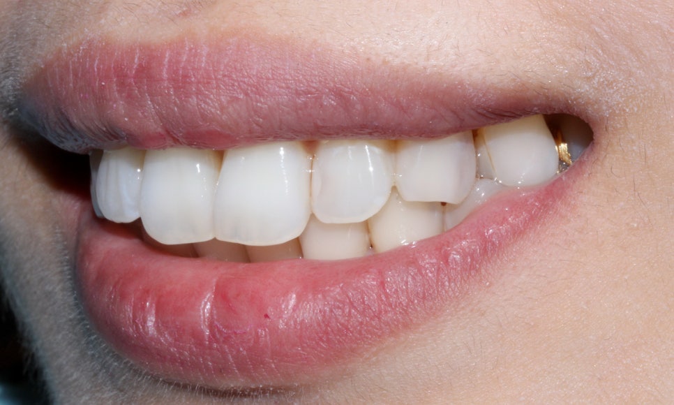 토끼 이빨 치아교정 5개월 교정 완료! by. 투디치과(2D치과) 관련 이미지 3