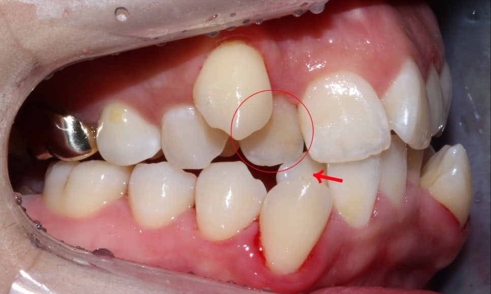 crowding 송곳니덧니 세라믹교정 방법 관련 이미지 5