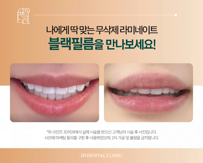 무삭제라미네이트비용 2D치과 변색치아를 하얗게! 관련 이미지 8