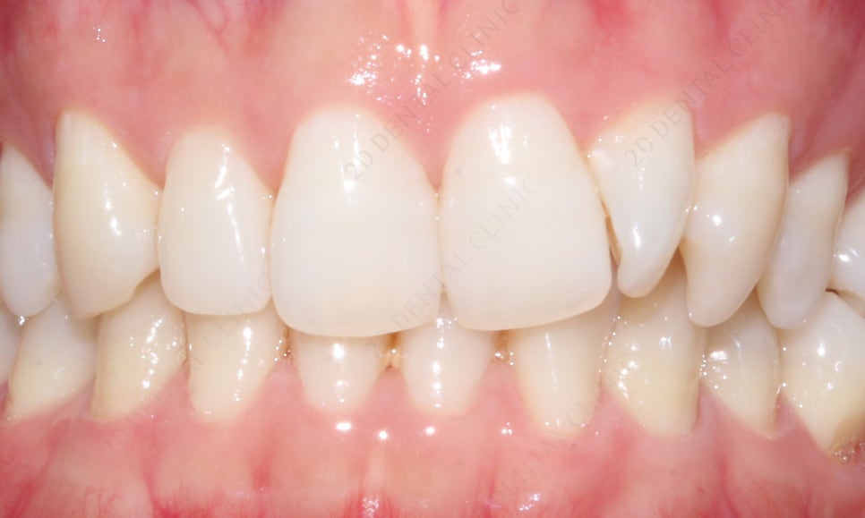 덧니치아 앞니교정 4개월 교정 완료! by. 투디치과(2D치과) 관련 이미지 5