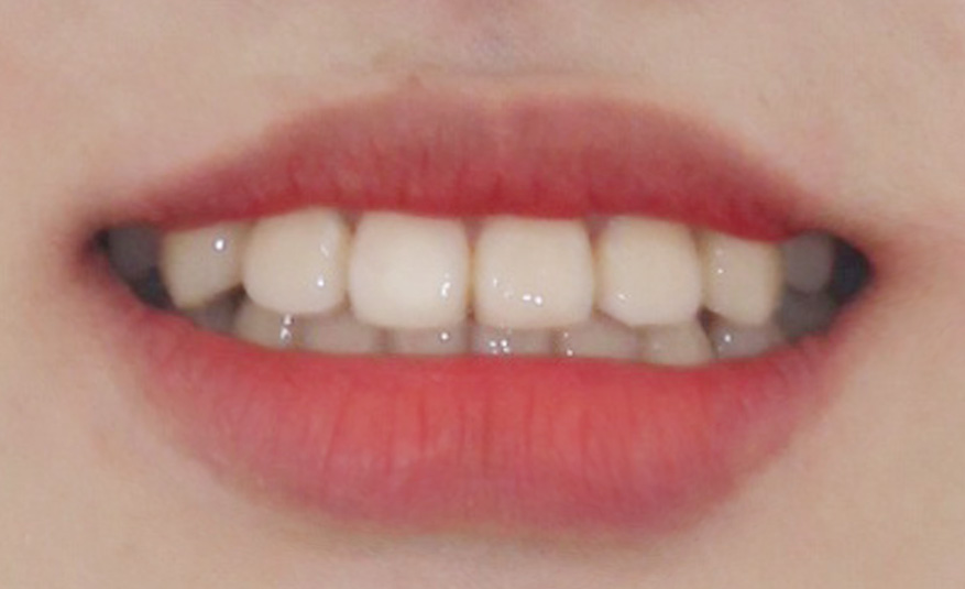 우디의 교정일기ㅣ덧니 치아교정 후기 (feat.부정교합) 관련 이미지 12