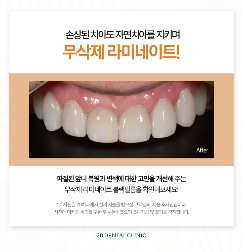 부산무삭제라미네이트 영구치앞니깨짐 어떻게 해야 좋을까요? 관련 이미지 7