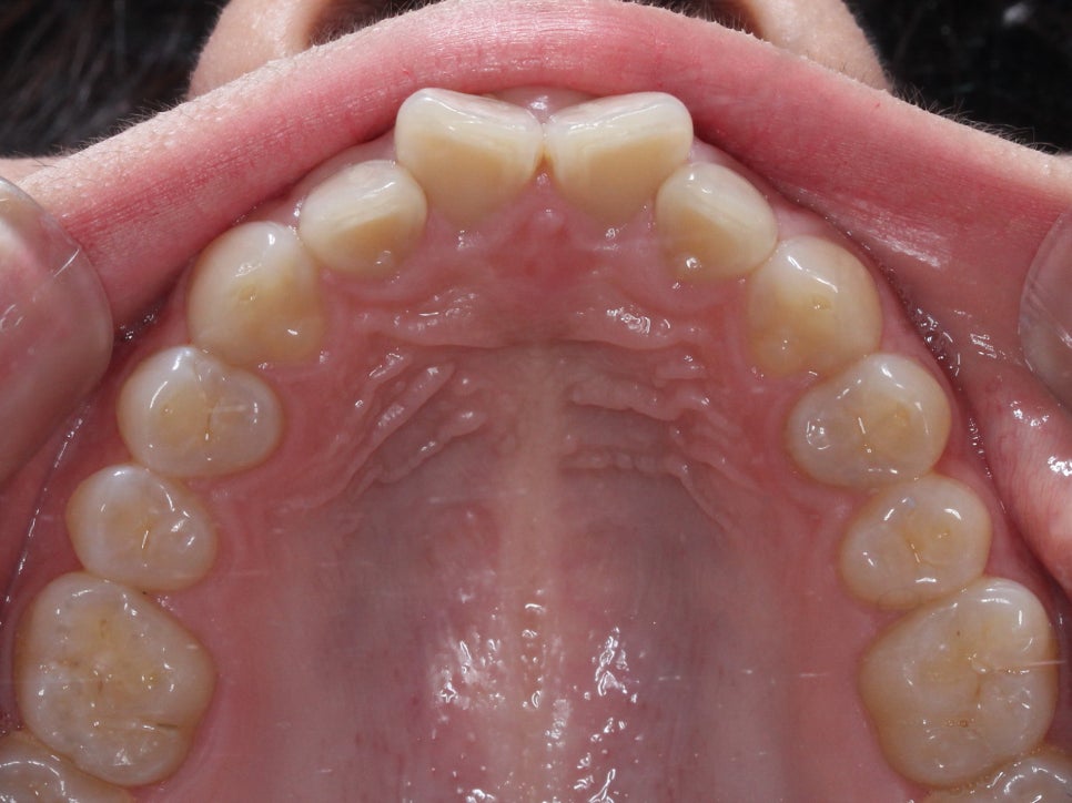 나비치아교정, 부분 치아교정으로 하고 싶다면? by.투디치과(2D치과) 관련 이미지 13