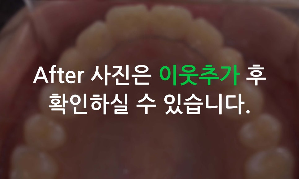 앞니틀어짐, 삐뚤어진 앞니를 부분교정하는 방법 관련 이미지 8