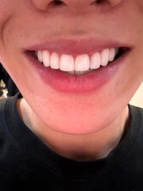 치아 심미치료 개선이 가능한 무삭제 라미네이트 블랙필름 관련 이미지 3