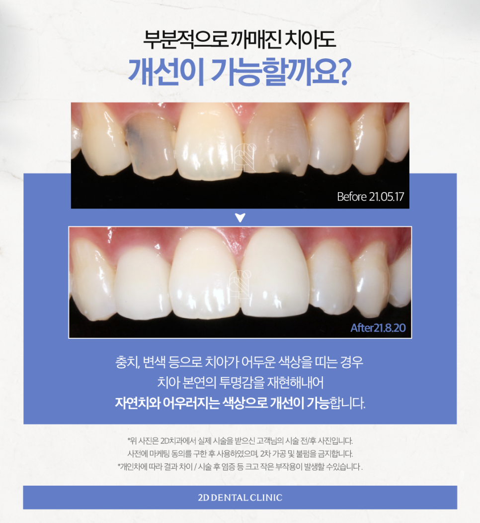 무삭제라미네이트후기 심미보철 나에게 적합한 방식을 찾아보세요 관련 이미지 4