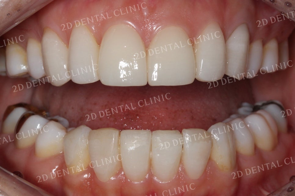 치아틈새를 완벽하게 메꾸자! 블랙트라이앵글 쎄라필름으로 완전 삭제! by.투디치과(2D치과) 관련 이미지 8