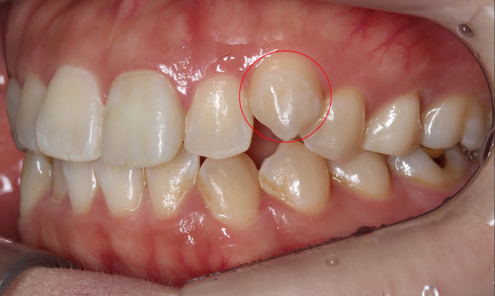 양악교정 송곳니교정 중심으로 관련 이미지 5