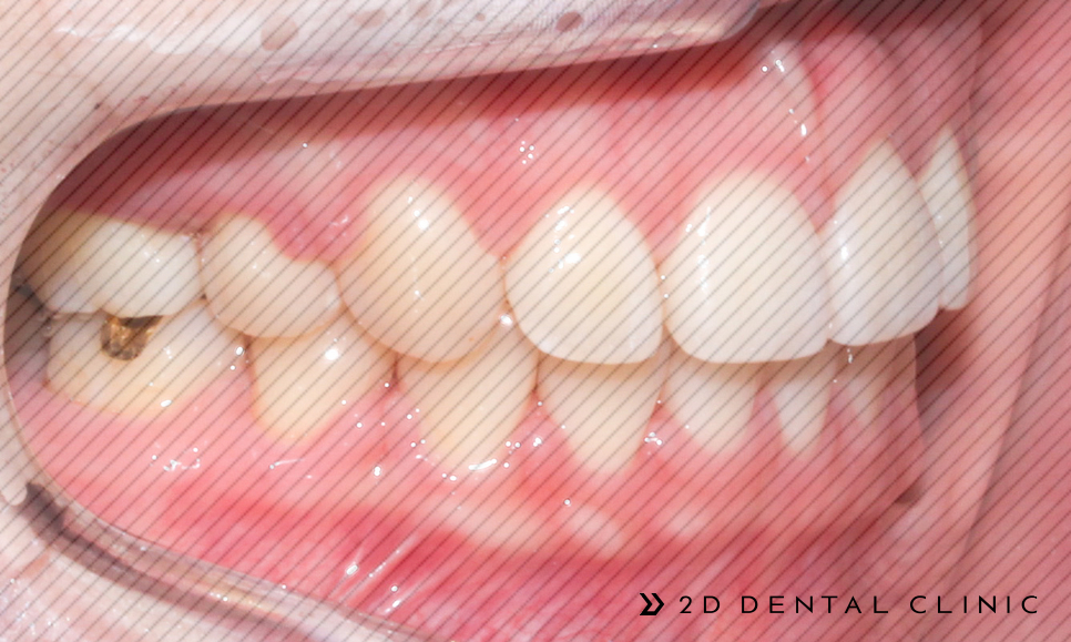 발치교정 돌출입 케이스, 교정전문 2D치과 관련 이미지 14