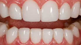 치아손상없는 깎거나 삭제없는 무삭제라미네이트가격 관련 이미지 7