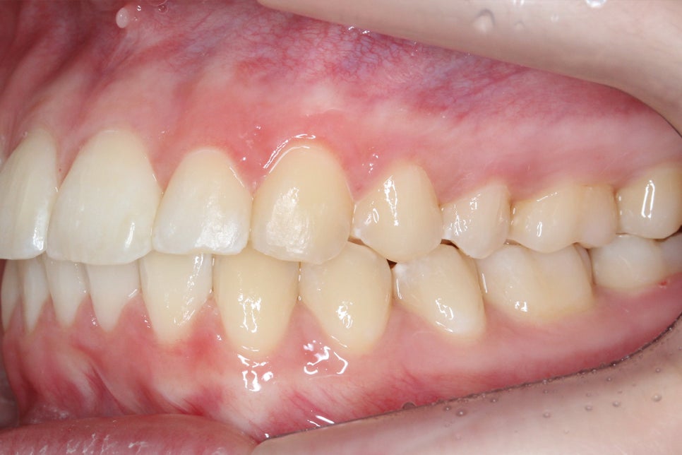 투디치과 송곳니덧니 치료 후기 관련 이미지 12