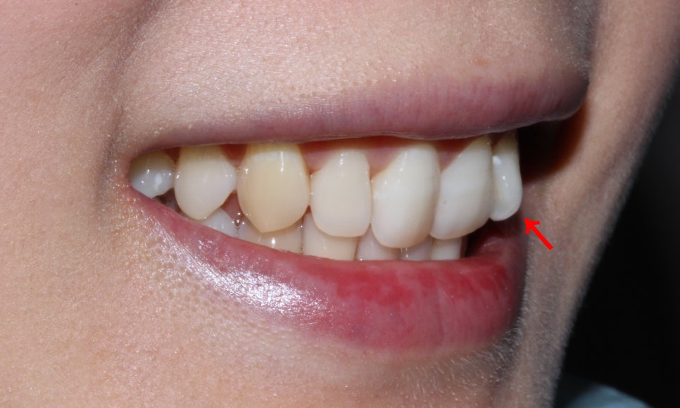 앞니틀어짐 2D교정으로 한번에 끝내는 방법! 관련 이미지 2
